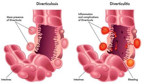 Diverticular Disease - Its causes, complications and treatment