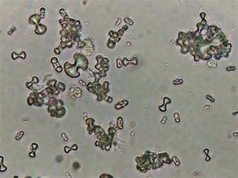 Examining Crystals in Urine Sediment - Med Lab Study Hall