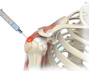 Barbotage for Calcific Tendonosis Of The Rotator Cuff | Advanced Orthopaedics & Sports Medicine ...