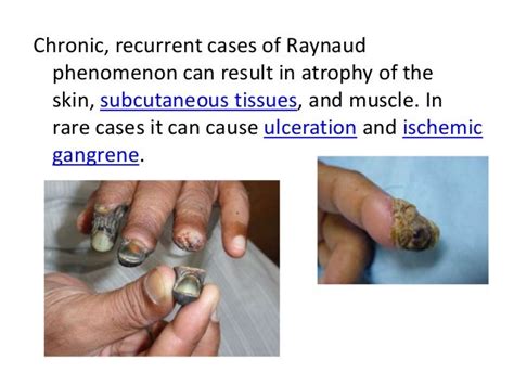 Raynaud’s phenomenon