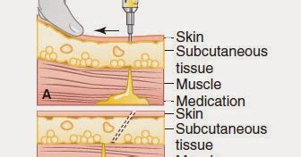 Intramuscular Injection Z-Track Method ~ Nursing