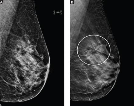 Breast cancer screening: Does tomosynthesis augment mammography? | Cleveland Clinic Journal of ...