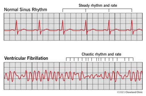 Ventricular Tachycardia Ecg