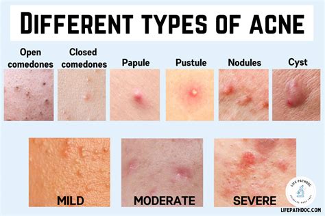 Different Types of Acne (with pictures) & Their Treatment