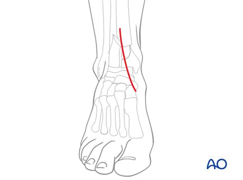 Anteromedial approach to the distal tibia