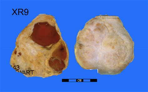 Neurilemmoma Showing Degenerate Change - Museum of Pathology