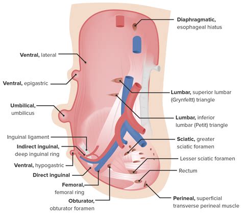 Abdominal Hernias | Concise Medical Knowledge