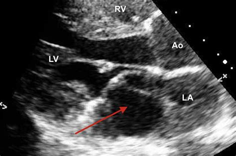 Transthoracic Echocardiogram | Download Scientific Diagram