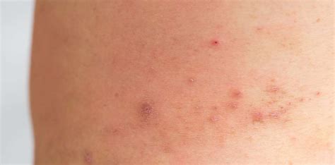 Ichthyosis Vulgaris: Symptoms, Causes, Treatments - Clear Skin Clinic