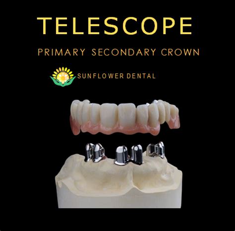 TELESCOPE - Shenzhen Sunflower Dental Lab