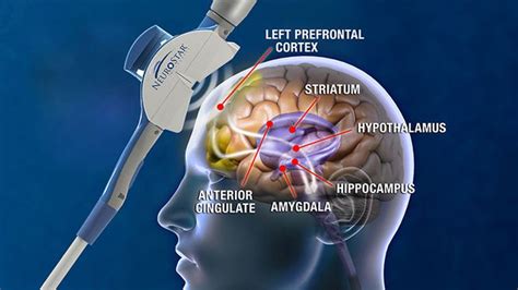 TMS therapy: Transcranial Magnetic Stimulation | Diamond Lake Clinic, Minneapolis