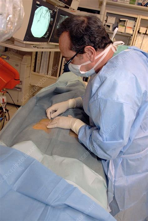 Balloon angioplasty surgery - Stock Image - C009/8360 - Science Photo Library