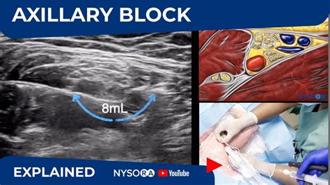 Ultrasound Guided Axillary Brachial Plexus Nerve Block - NYSORA