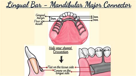 Lingual Bar - Mandibular Major Connector/ Removable Partial Dentures ...