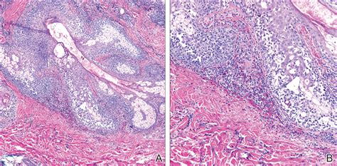 Eosinophilic Pustular Folliculitis Histology