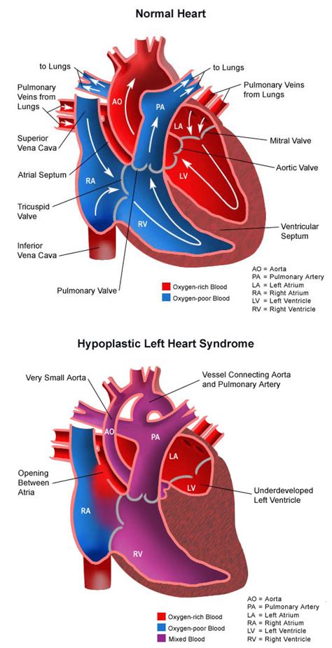 Hypoplastic Left Heart Syndrome - Children's Hospital of Orange County