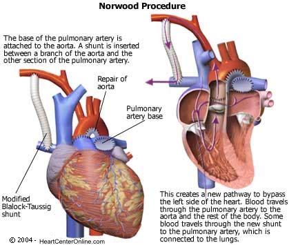 Norwood Operation