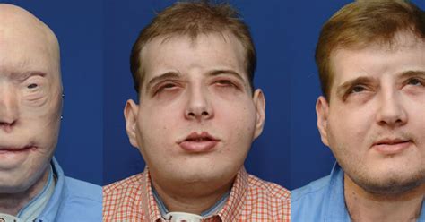 Incredible Transformation Of Face Transplant Recipient Who Feels 'Normal' For First Time In 15 Years