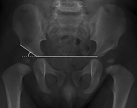 Measuring the Acetabular Index: An Accurate and Reliable Alternative Method of Measurement | AJR