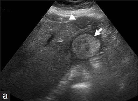 WK 2 LIVER PATHOLOGY Multiple hepatic adenomas. (a) Transverse ...