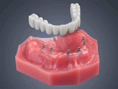 How long do mini dental implants last - Dental News Network