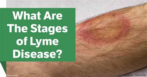 Lyme Disease Rash Stages