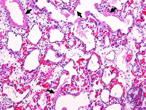 22.Pediatric pathology (6) Hyaline membrane disease・Neonatal ...