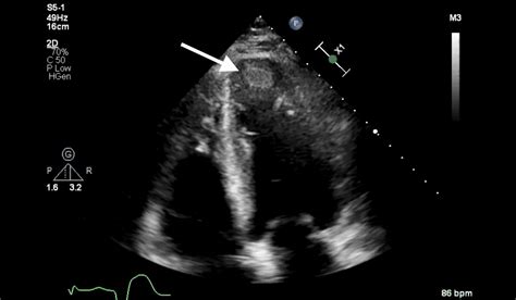 Cureus | Left Ventricular Thrombus After Acute Decompensated Heart Failure in the Setting of ...