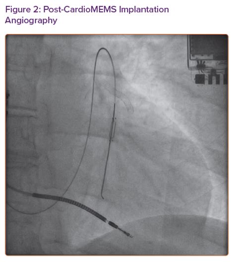 Post-CardioMEMS Implantation Angiography | Radcliffe Cardiology