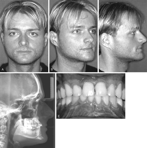 SAGITTAL SPLIT OSTEOTOMY | Pocket Dentistry