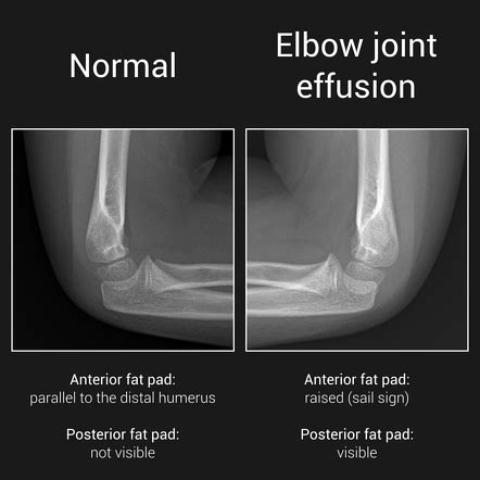 Right Elbow X Ray Fat Pad