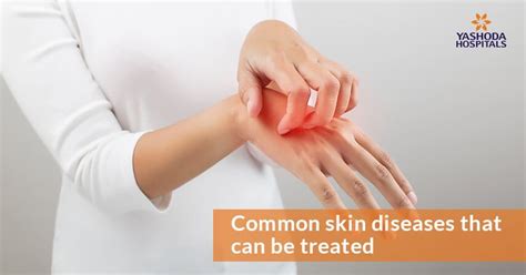 Skin Diseases: Causes, Symptoms, Prevention and Treatment