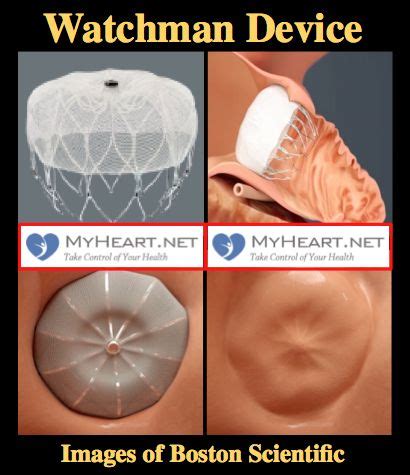 What is the Watchman Device (Also known as Watchman Procedure, Watchman ...