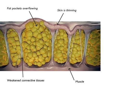 Traitement Anti Cellulite Efficace | Système Médical RF D-Actor