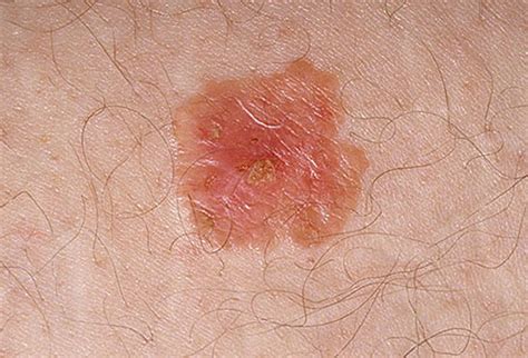 Pictures of skin cancer: Skin cancer symptoms images