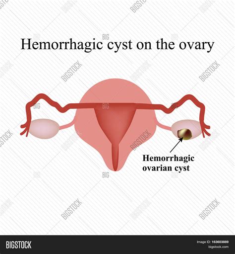 Hemorrhagic Cyst On Image & Photo (Free Trial) | Bigstock