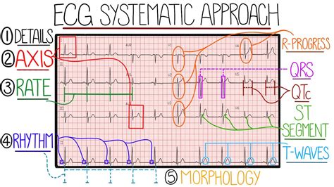 ECG Interpretation Made Easy (Learn How to Interpret an ECG in 13 ...