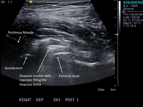 MSK Ultrasound Procedures