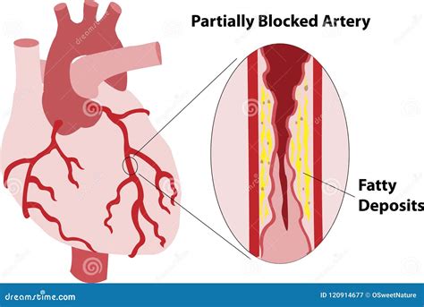 Coronary Artery Spasm Royalty-Free Stock Photography | CartoonDealer ...