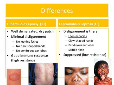 Tuberculoid vs Lepromatous Leprosy - MEDizzy