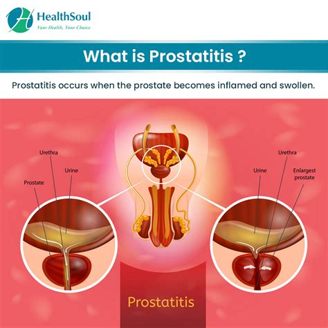 Prostatitis: Symptoms, Diagnosis and Treatment – Healthsoul