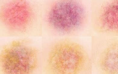 Stages of Bruising Colors, Pictures, Chart and Different Bruise Healing Stages