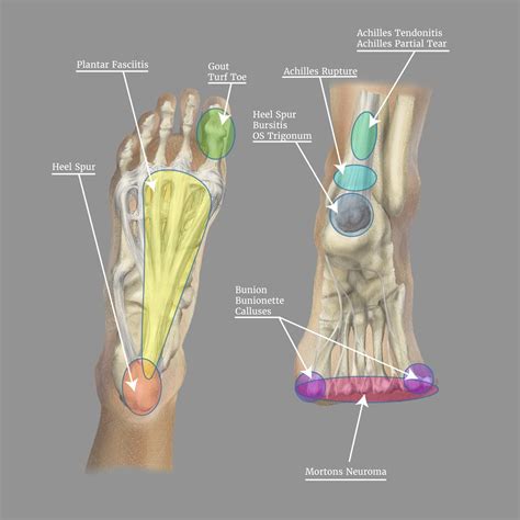 Foot Pain Identifier Chart Hot Sex Picture | Hot Sex Picture