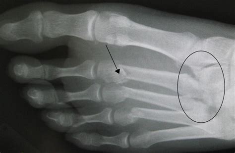 Lisfranc fracture: Causes, symptoms, and treatment