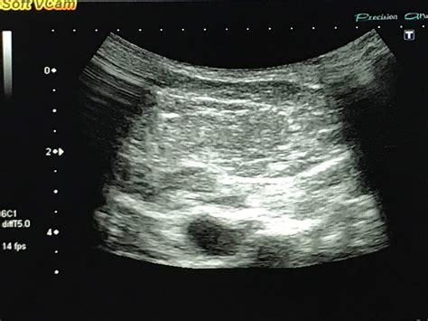 Lipoma Ultrasound