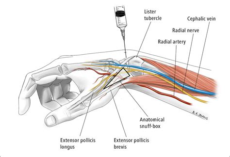 How To Do It: Wrist Arthrocentesis