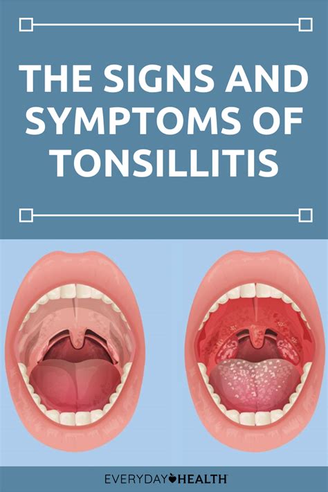 How Do You Know if You Have Tonsillitis? | Symptoms of tonsillitis, Symptoms, Swollen tonsils