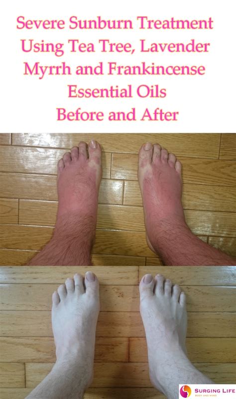 Essential Oils For Sunburn Treatment – Mild To Severe — SurgingLife