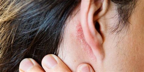 Fungal Ear Infection Symptoms And 4 Best Treatment Options