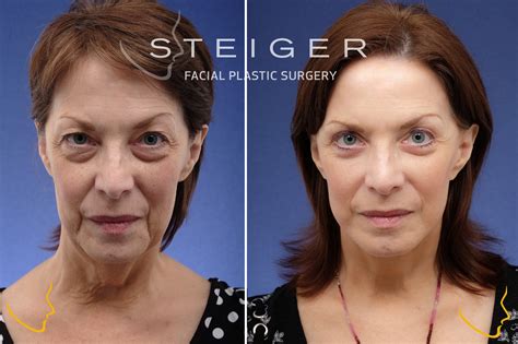 Facelift Before and After Photos | Deep Plane Facelift